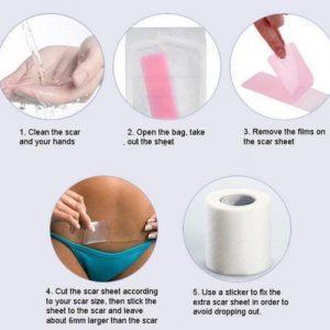 Miracle Scar Removal Tape - 4 Seasons Home Gadgets